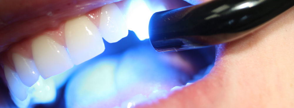 Dental Fillings Treatment - Dr. Seini, Dentist, near Orange, California