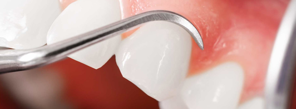 Gum Grafting - Dr. Seini, Orange, California Dentist