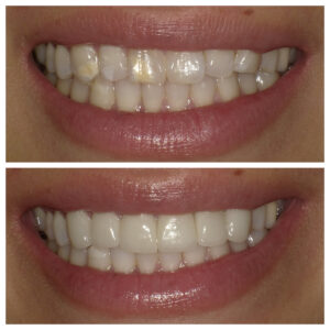 Before and After Veeners - Orange Cosmetic Dentistry