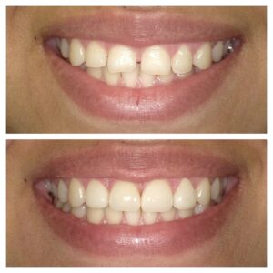 Before and After Veeners - Orange Cosmetic Dentistry